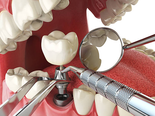 Best Emergency Tooth Extraction in Powers Lake, WI
